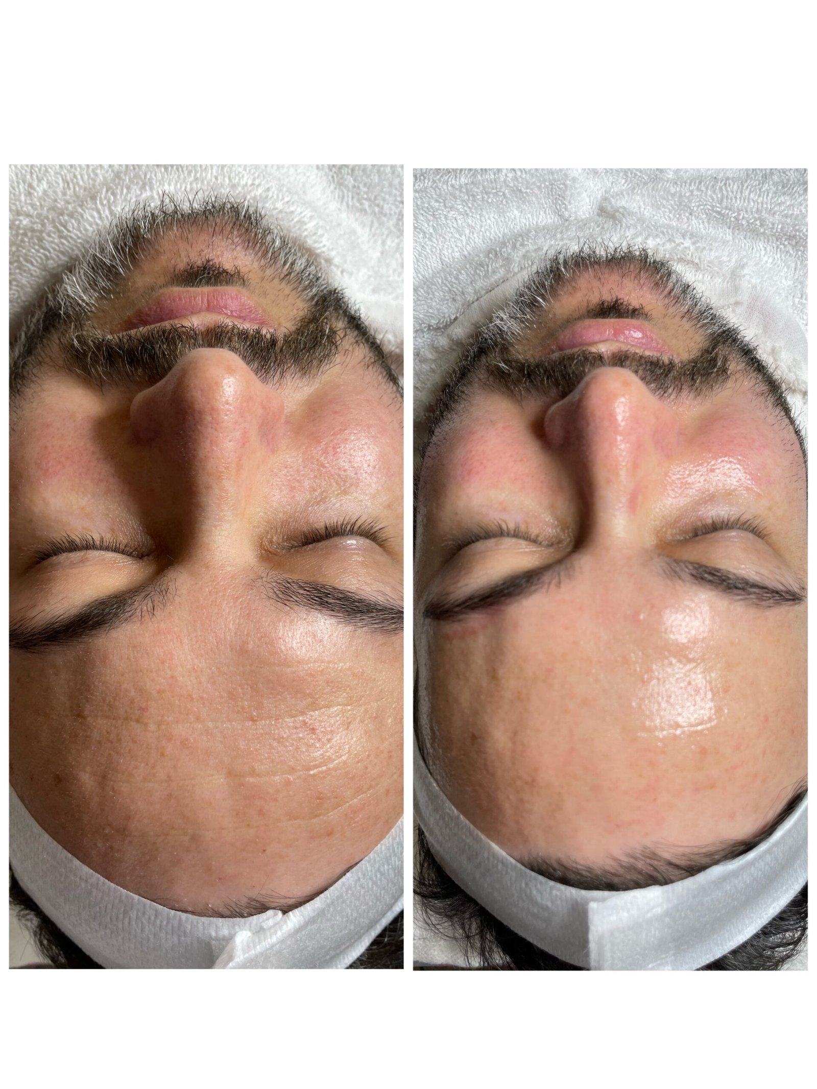 Rejuvenecimiento facial