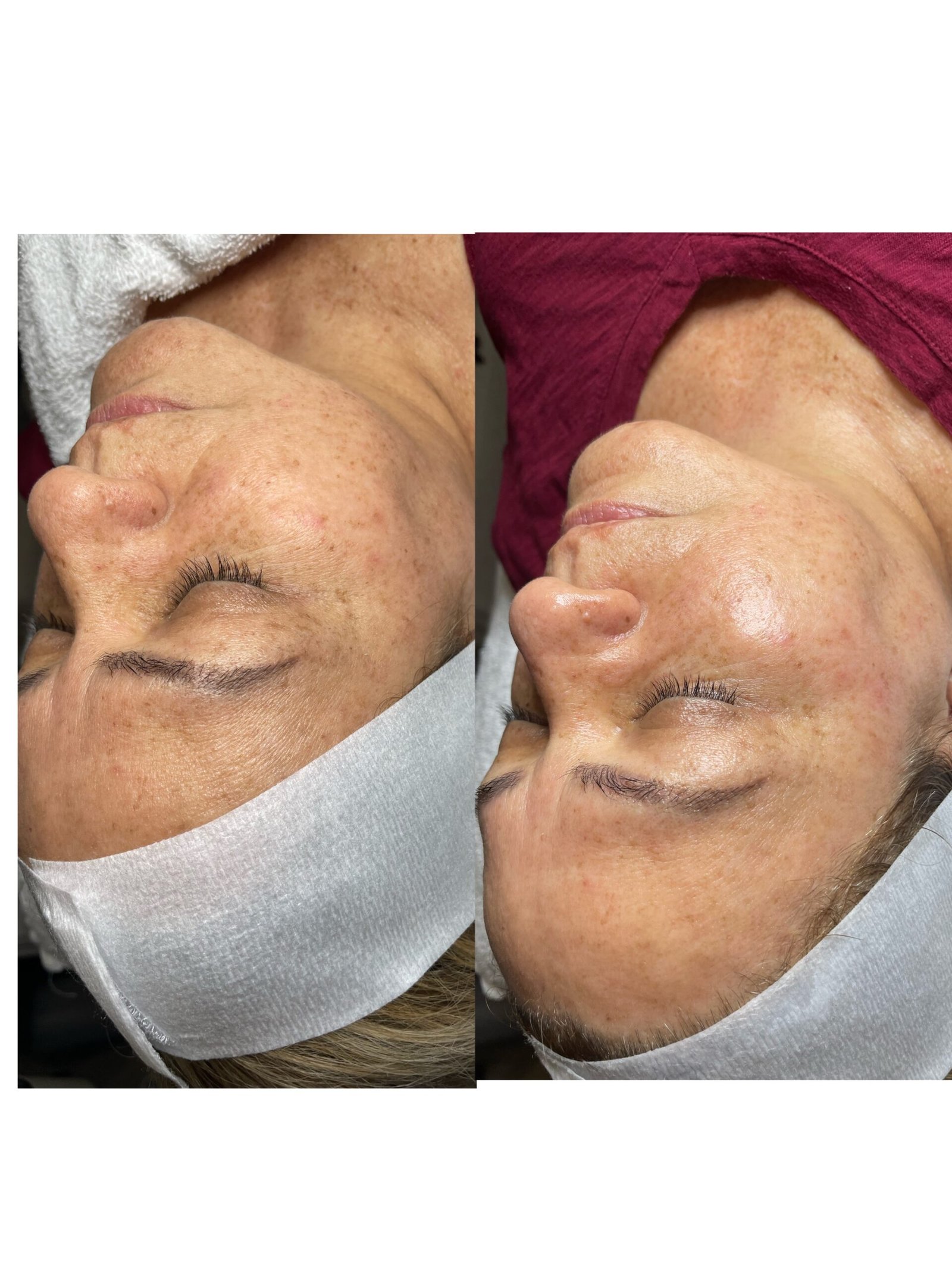 Limpieza facial profunda