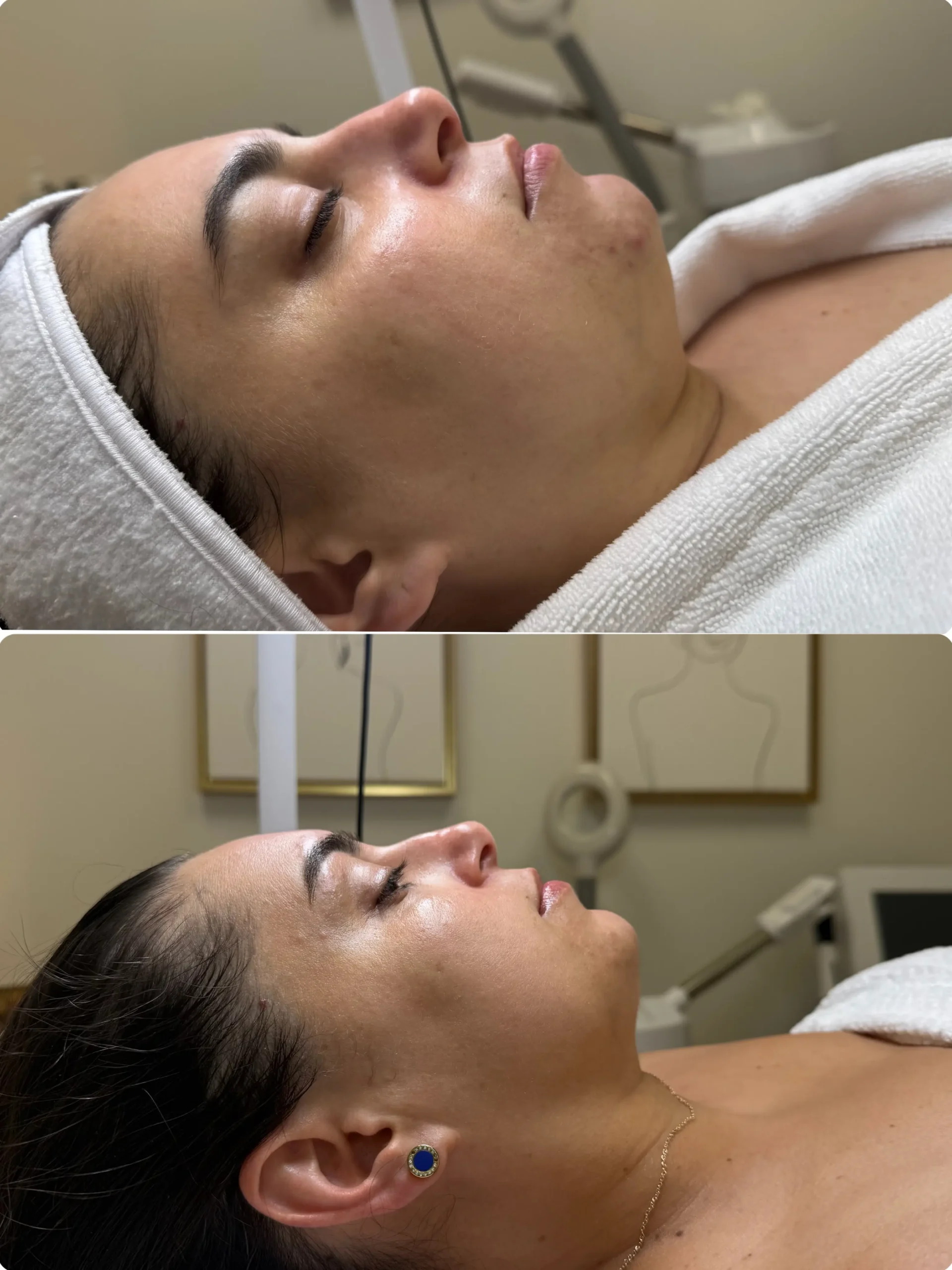 antes y despues Ultherapy